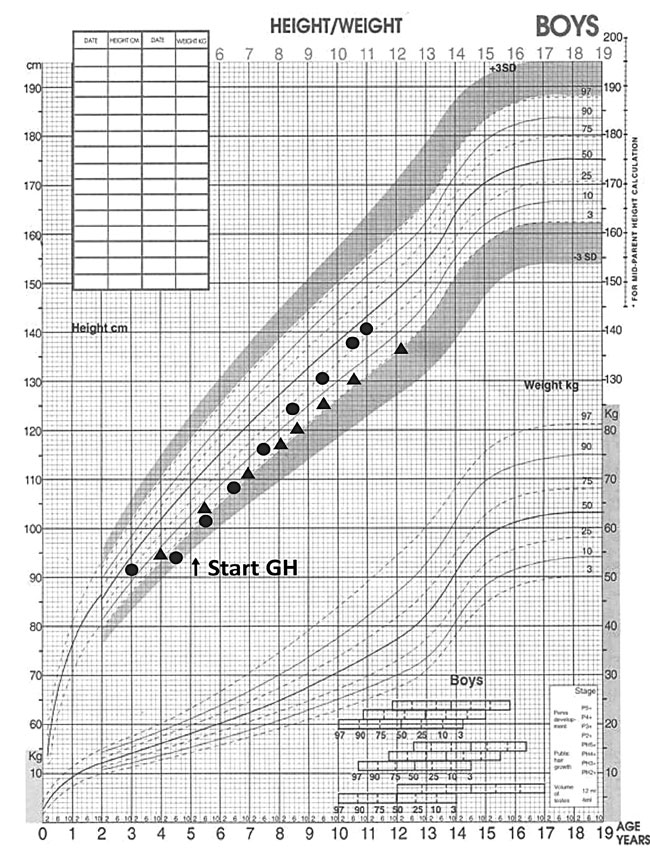 Noonan Syndrome Growth Chart