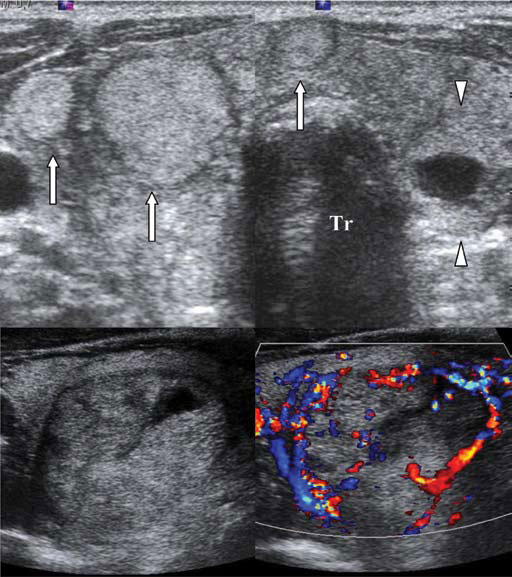 Multinodular Goiter Ultrasound
